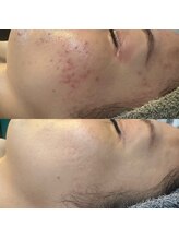 アルム(a'rme)/【ニキビコース】