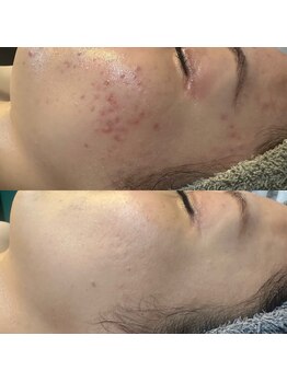 アルム(a'rme)/【ニキビコース】