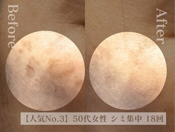 ディレイア ザ コスメ 有楽町マルイ店(direia the cosme)の写真/ダウンタイム無し！気になるシミの改善◎【肌代謝促進でシミもたるみ合わせてケア】[有楽町/毛穴/小顔]