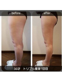 ビューティーサロン ルクール エステ(beauty salon le Coeur Este)/トリプル痩身　before・after