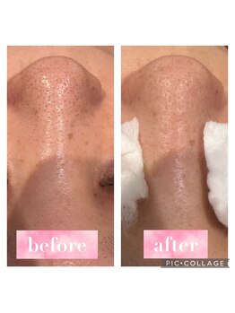 エステテックサロンラレーヌ 小山店(La Reine)/ハイドラ毛穴フェイシャル