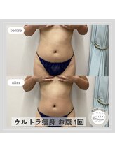 カラー(CALLA)/腸活/くびれ作り/ぽっこりお腹に