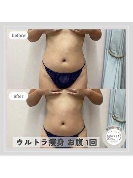 カラー(CALLA)/腸活/くびれ作り/ぽっこりお腹に