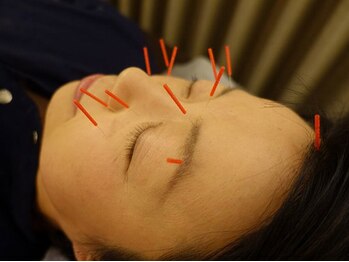 中国鍼灸院 はこしま医針堂/花粉による症状(鼻水など)