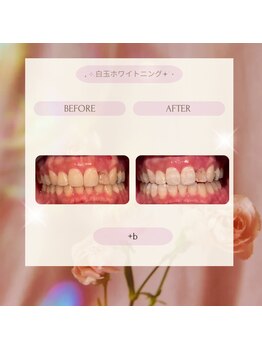 プラスビーセルフ(+b self)/ホワイトニングビフォーアフター