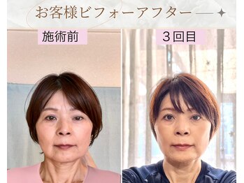 プランドール/えらの張り、目の左右差が軽減♪