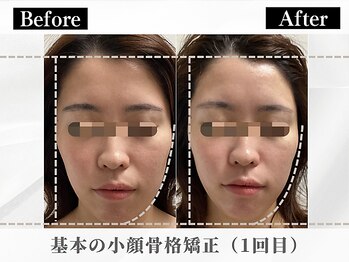 ポーベルポー(Peau Belle poe)/基本の小顔骨格矯正（１回目）