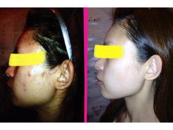 ヨサパーク パーチェ(YOSA Pace)/お肌も改善!