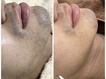 エミュ(emu formen)/宮崎県延岡市のメンズ脱毛