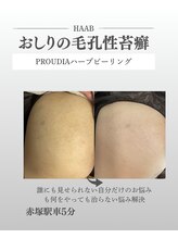 プラウディア(PROUDIA)/ニキビ/ボディハーブピーリング