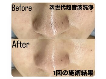 イリゼ(IRISE)の写真/《夏のダメージ毛穴を徹底大掃除！》大好評！3D毛穴洗浄×韓国式ピーリング×イオン導入で美肌×ヘッドスパ