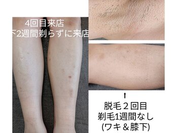 エイプリルプラス(April plus)/脇脱毛　ひざ下脱毛