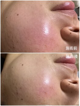 ブライトリー(Brightly)/改善スピードが上がる施術です!