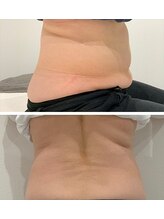 ユウキ(yuuki)/痩身before