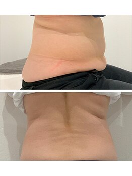 ユウキ(yuuki)/痩身before