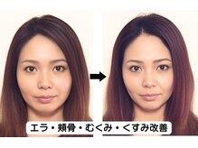 ニュートラル 池袋店(NEUTRAL)/施術結果【小顔、毛穴】