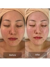 エメ(Aimer)/【30代EXフェイシャル結果☆】