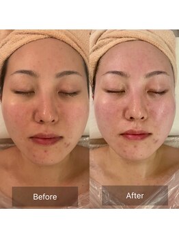 エメ(Aimer)/【30代EXフェイシャル結果☆】