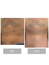 ダンニヒル(dannihil)/【顔脱毛】脱髭剃り負け