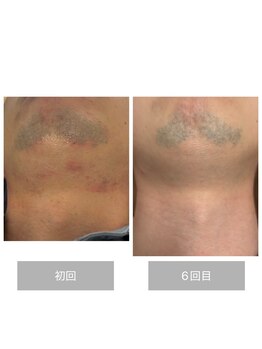 ダンニヒル(dannihil)/【顔脱毛】脱髭剃り負け