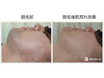 メンズ脱毛サロン アカラ(AKALA)/ヒゲのビフォーアフター