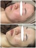 つるんと透明感、触れたくなる白玉肌へ【ゾンビパック】