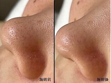 アム バイ オーキッド 代々木公園(UM by ORCHID)/毛穴・ニキビケア