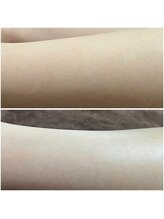 ルアナ(Luana)/うぶ毛もない、うるつや肌に。