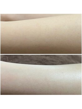 ルアナ(Luana)/うぶ毛もない、うるつや肌に。