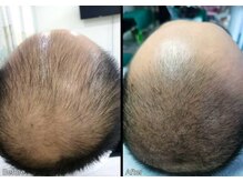 キュライム 熊本(CURAIM)/育毛促進【50代男性】