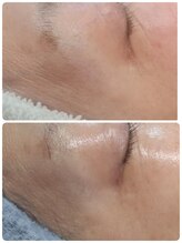 ココ(COCO)/一度で実感！しわ目尻のシワ改善