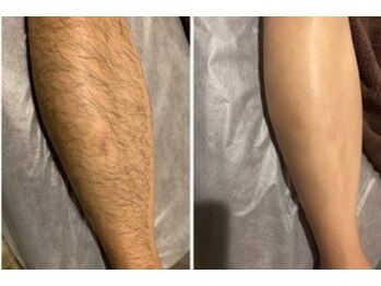 BRUSH/脱毛でスッキリ清潔感のある肌へ