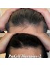 【再！！プロセルモニター募集】次世代育毛促進プログラム＊頭皮のお悩み解消
