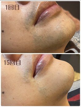 ルタンリッシュオム(Lutan Riche hom)/ヒゲ脱毛 途中経過