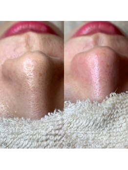 エミナル(Eminal)/◇毛穴エクストラクションtete式