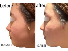 マドモアゼル 麻布十番/術後インディバ