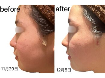 マドモアゼル 麻布十番/術後インディバ