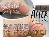 【新メニュー】フット巻爪補正　導入キャンペーン　1本 【片足】