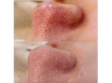 ミヨン(miyong)の雰囲気（サロンでは珍しいフラクショナルで鼻の毛穴改善）