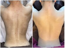 福岡美人工房 アロマムーン/ハーブピーリングで背中ニキビも