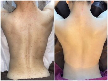 福岡美人工房 アロマムーン/ハーブピーリングで背中ニキビも