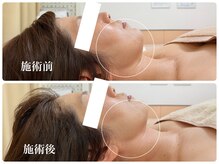 キーオブフェイス(Key of Face)/「RED SHOT」で小顔に！