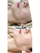 ジュエルビューティー(Jewel Beauty)/ピーリング