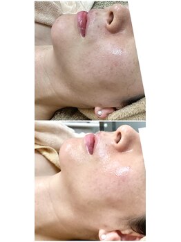 ジュエルビューティー(Jewel Beauty)/ピーリング