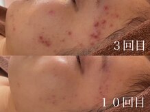 アワピール 天王寺店(AWA PEELL)/ハーブピーリング/ニキビケア