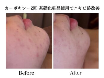 ナチュラーレ 天王寺店(Naturale)/美肌ニキビケア小顔フェイシャル