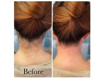 アイリス(AIRIS)/うなじWAX脱毛