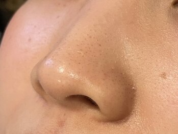 オアシスラグーン(OASIS LAGOON)/毛穴ケア(症例3:before)