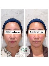 キュープ 相模原淵野辺店(Qpu)/たった4回で人生で1番小さな顔に