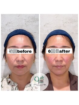 キュープ 相模原淵野辺店(Qpu)/たった4回で人生で1番小さな顔に